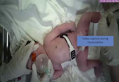 Neonatal resuscitation monitoring: A low-cost video recording setup for quality improvement in the delivery room at the resuscitation table